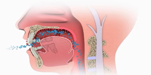 マイオブレース